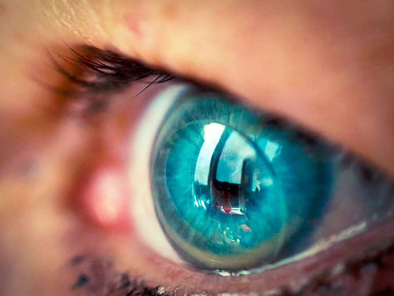 évolution des lentilles