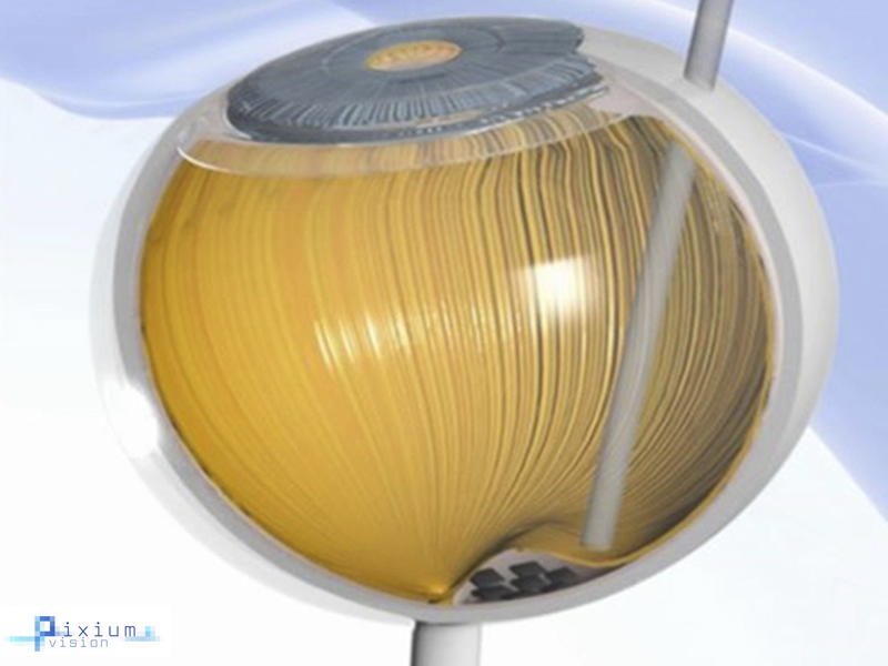 pixium_prima_implant